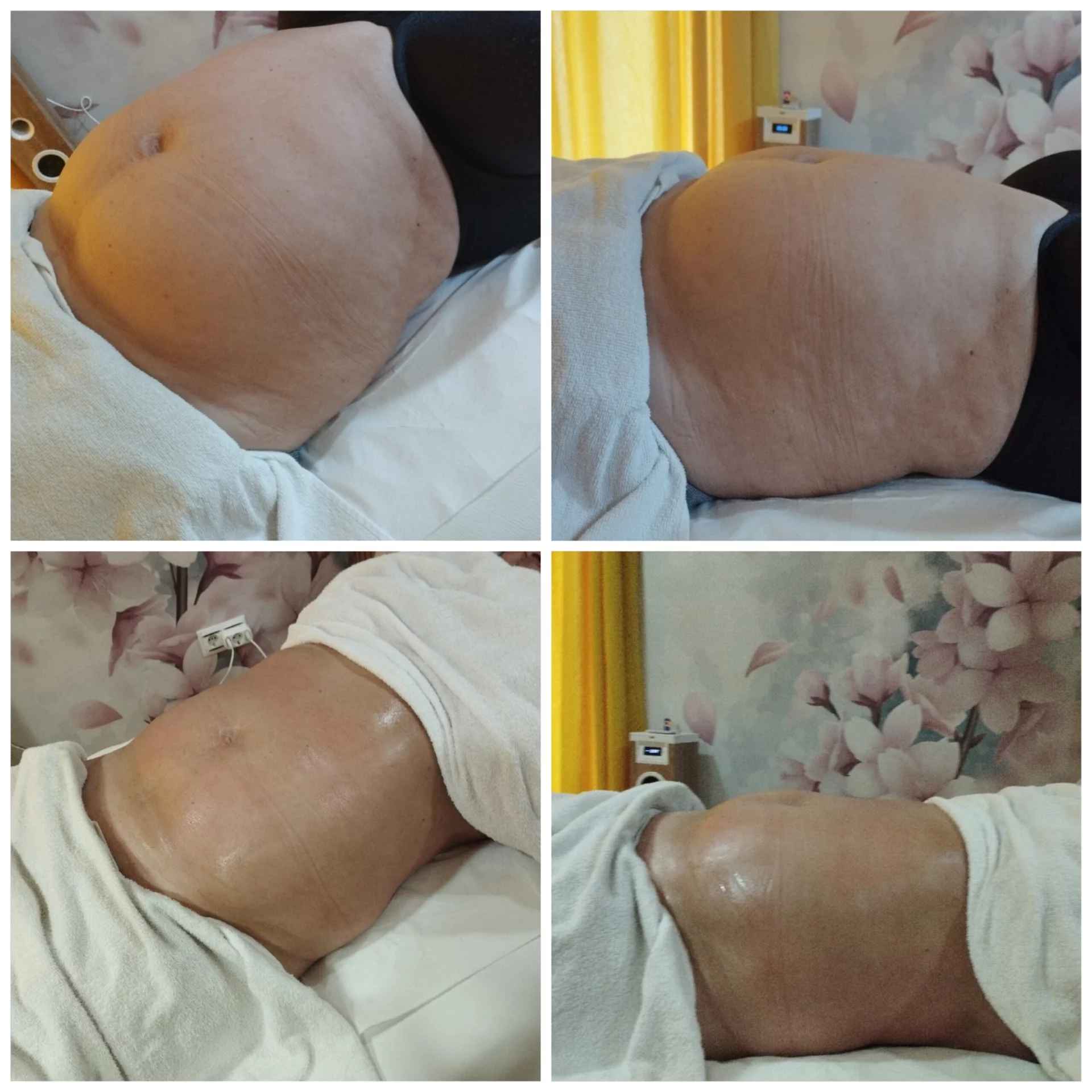 Resultado de sesiones de vacumterapia